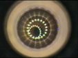 k&eacute;ratectomie stromale circulaire pour presbytie: IntraCore