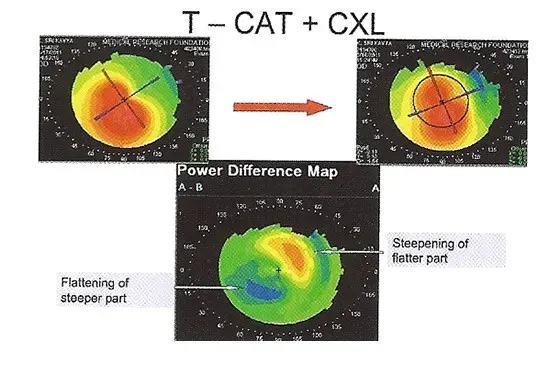 T-CAT+CXL