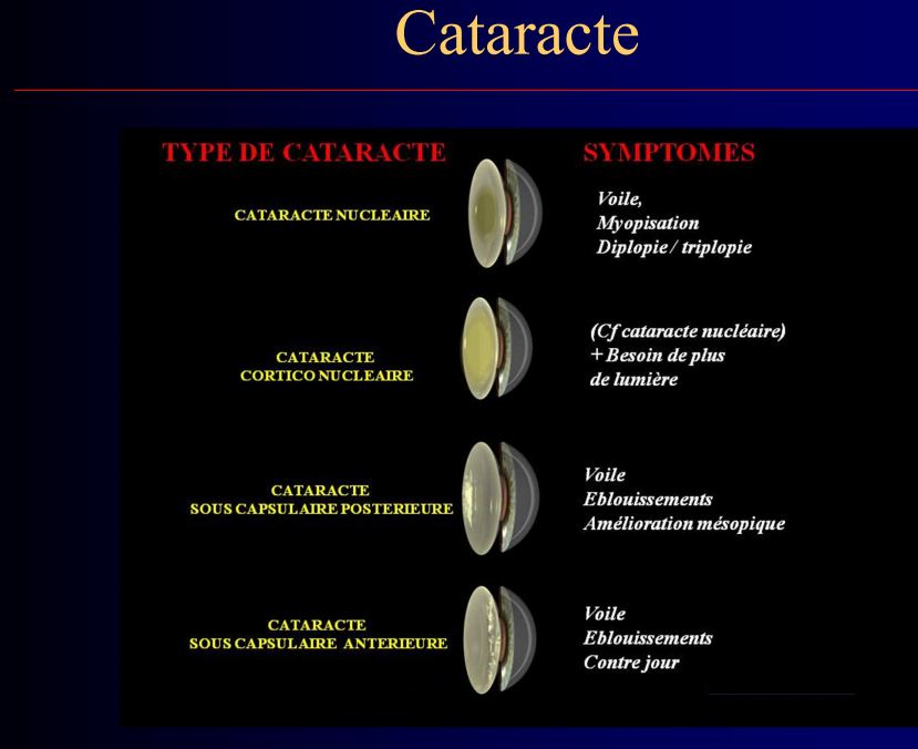 Cataracte