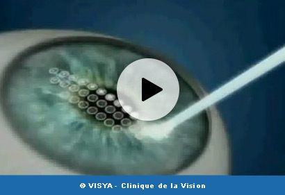 Opération LASIK