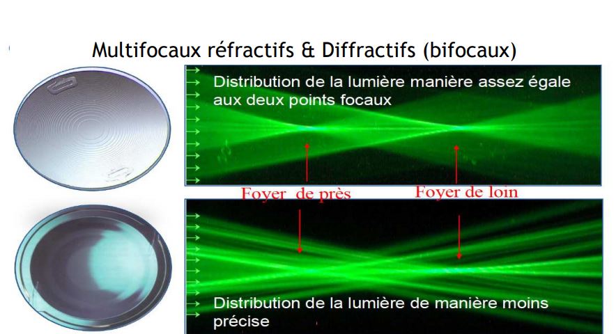 Multifocaux réfractifs et diffractifs (bifocaux)