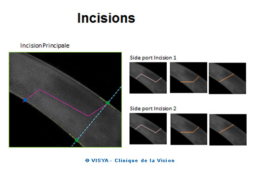 Incisions