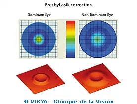 PresbyLasik correction