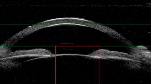 OCT : implant ICL (ou Visian) en place