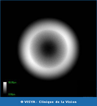 Anneau périphérique circulaire de l'ablation excimer pour hypermétropie