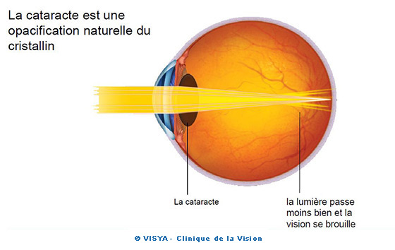 La cataracte est une opacification naturelle du cristallin