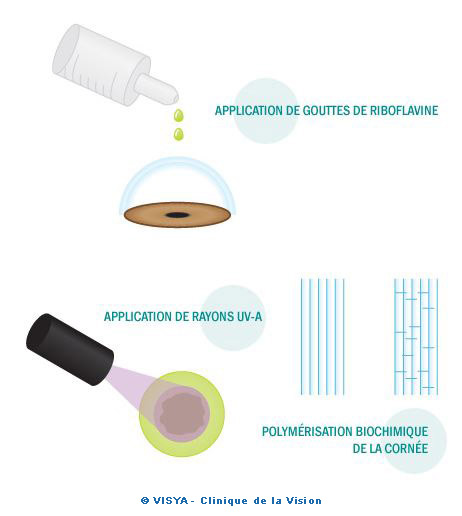 Application de gouttes de Riboflavine