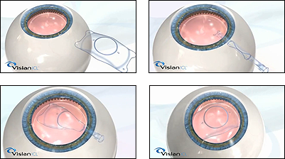 IMPLANT TYPE icl