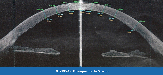 kératoplastie LAMELLAIRE PROFONDE