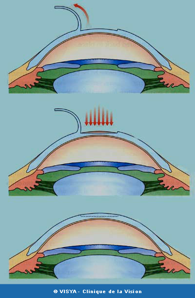 LASIK 