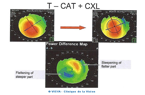 T-CAT+CXL