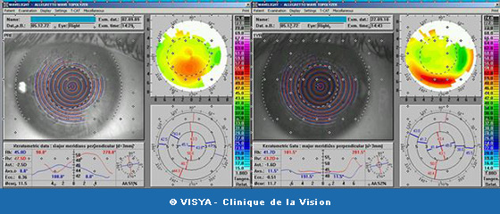 Le cliché montre une guérison de myopie par PKR sur kératocône (TopoLink)