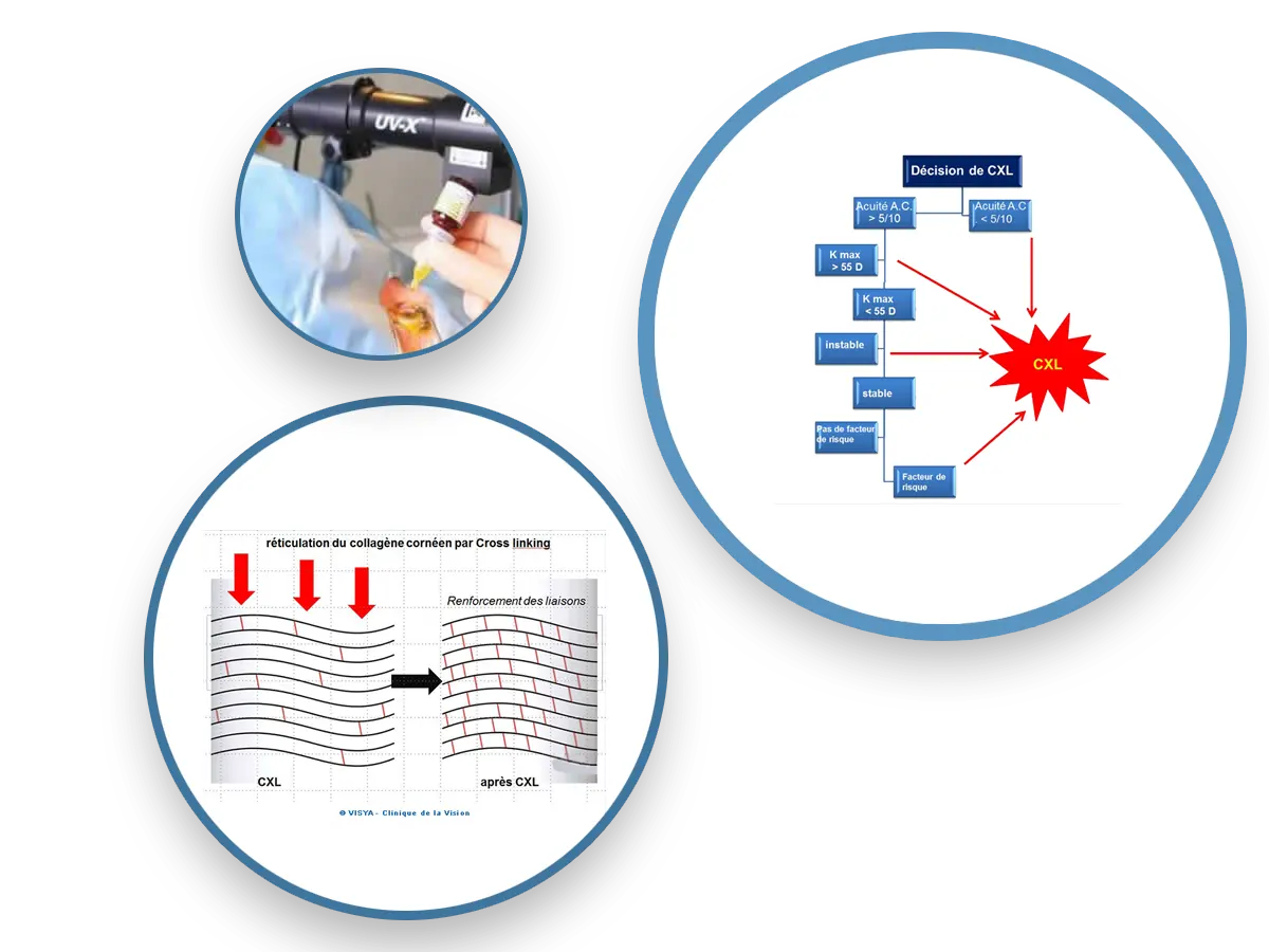 Clinique de la Vision - Les étapes du traitement