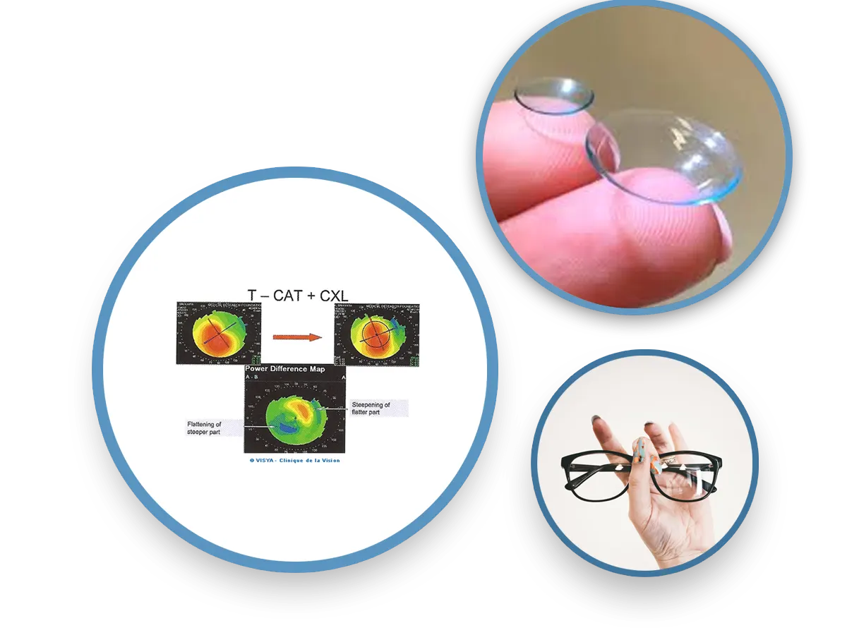 Clinique de la Vision - Les étapes du traitement