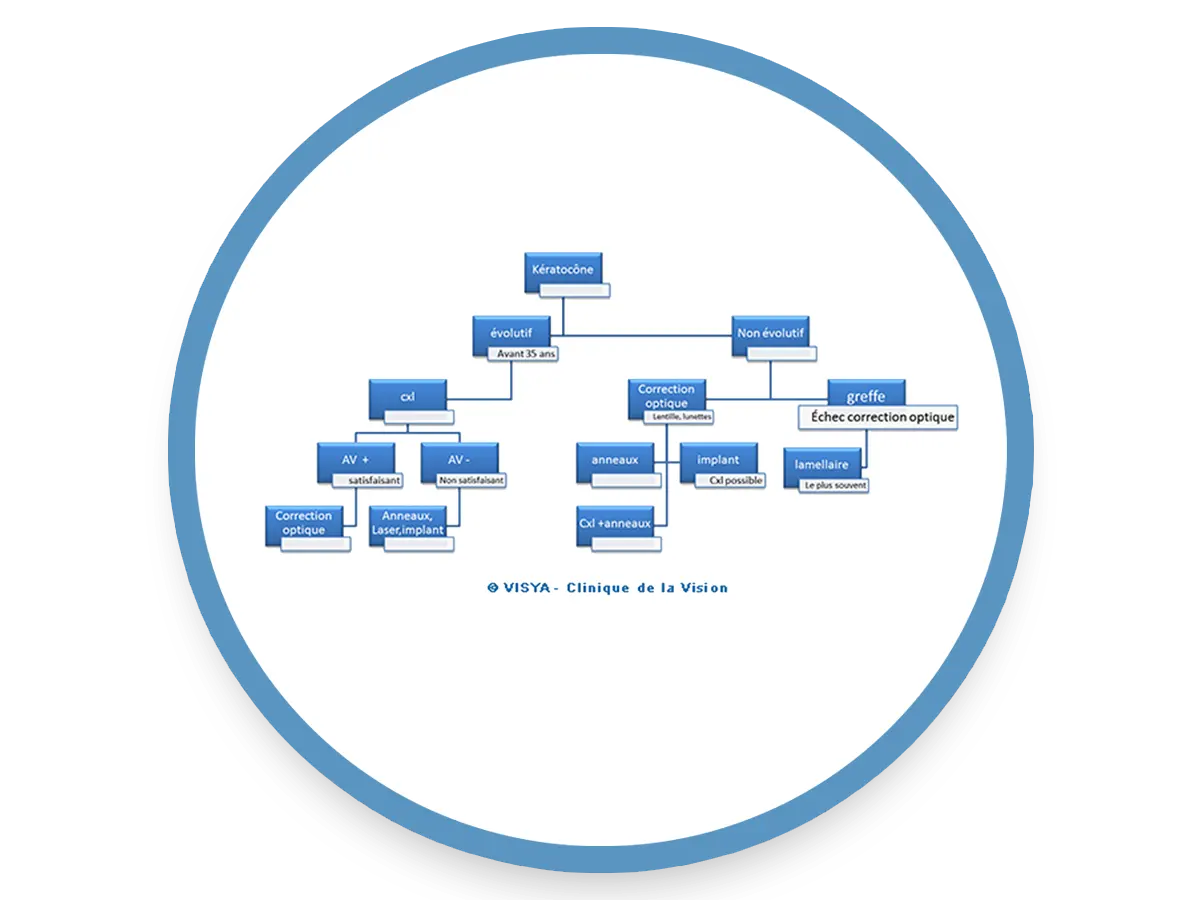 Clinique de la Vision - Les étapes du traitement