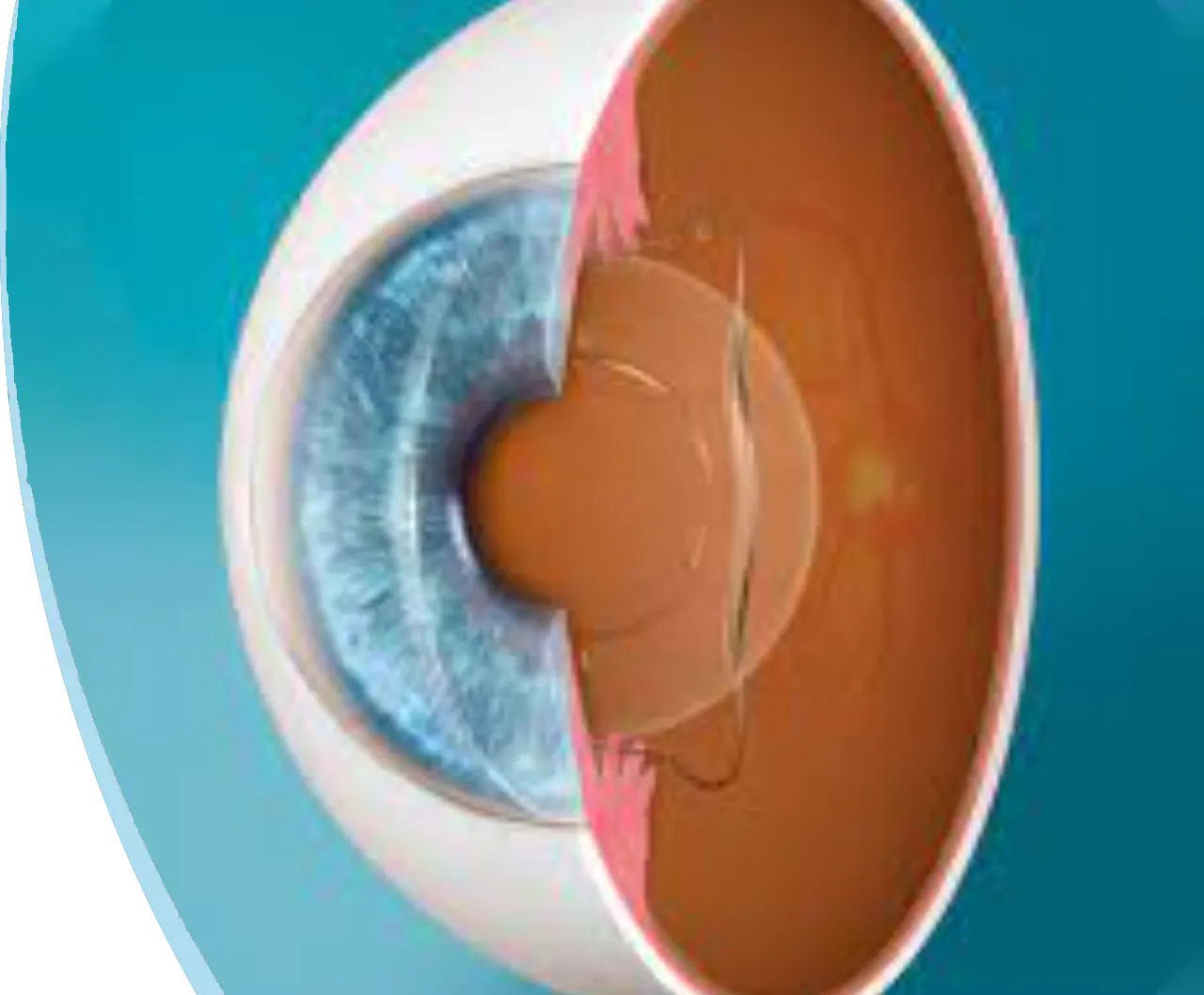 Implants phaques (ICL)