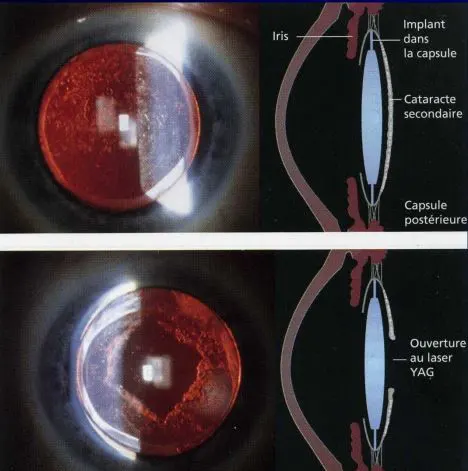 La cataracte secondaire