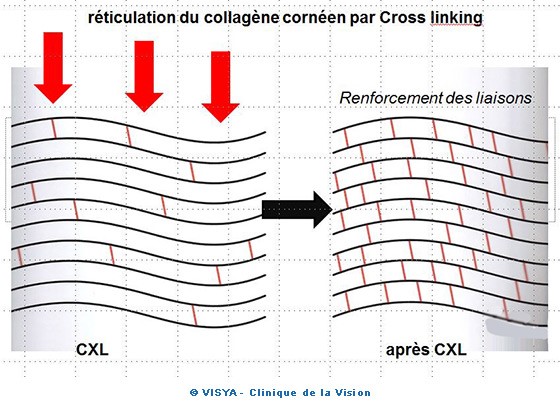 Réticulation du collagène cornéen par Cross linking