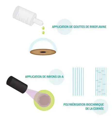 Application de gouttes de Riboflavine