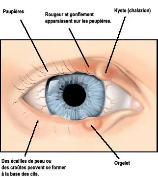 La sécheresse oculaire